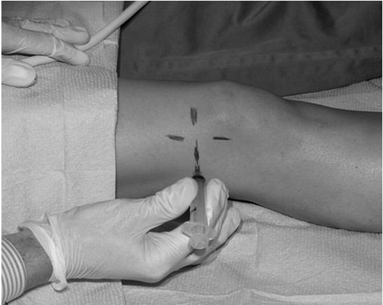 Needle Placement for Joint Aspiration Ultrasound