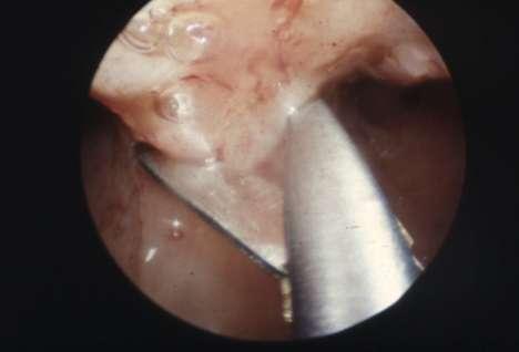 Currently, operative hysteroscopy is proposed as the procedure of choice for the management of