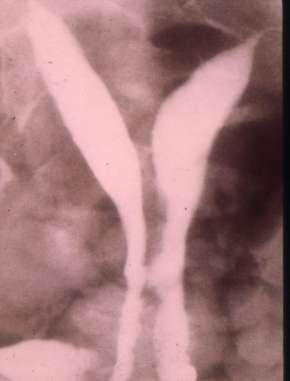 Complete septate uterus, duplicated cervix,