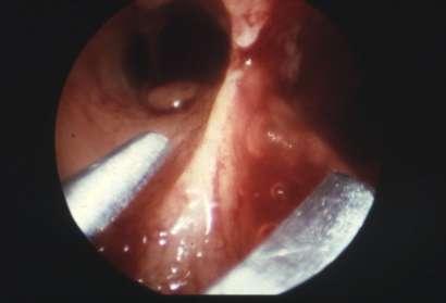 Therefore hysteroscopic metroplasty results seem to be at least as good as those obtained after the abdominal metroplasty.