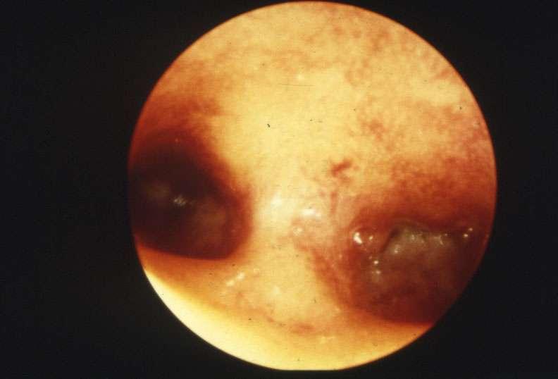 Uterine septum is the most common Mullerian fusion defect.