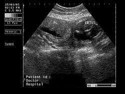 Septate uterus has been linked to a high grade of fetal loss generally occurring during the first half of the pregnancy