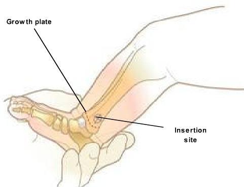 Pediatric distal tibial insertion: The insertion site is approximately one finger width (patients less than 12 kg) and one to