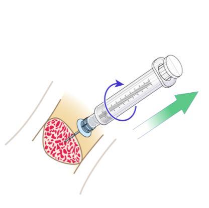 The IO catheter stands straight up at a 90 degree angle and is firmly seated in the tibial bone. b. Blood at tip of the stylet (sometimes visible). c. Aspiration of a small amount of bone marrow with a syringe.