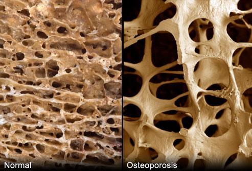 Bone naturally looks like a honeycomb If you have osteoporosis, the honeycomb has