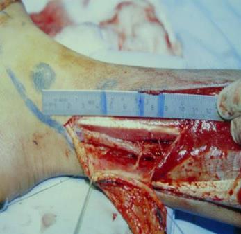 using a posterior tibial