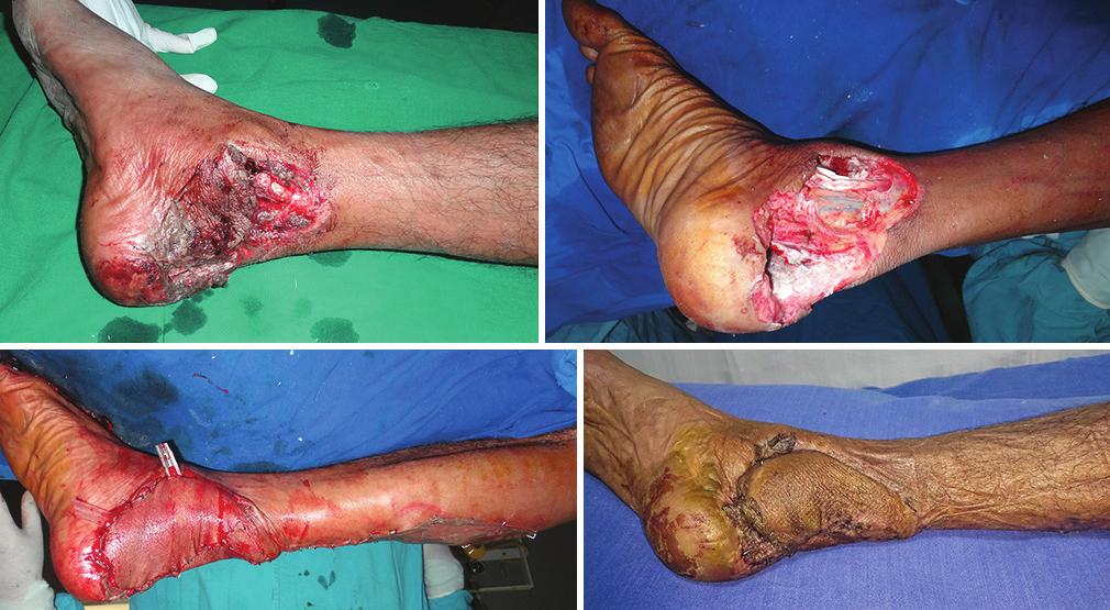a Almeida et al. [3] experienced partial flap necrosis (22.1%), total flap necrosis (4.2%), infection (8.5%) and venous congestion (4.1%) in a total of 71 cases of transferred reverse sural flaps.