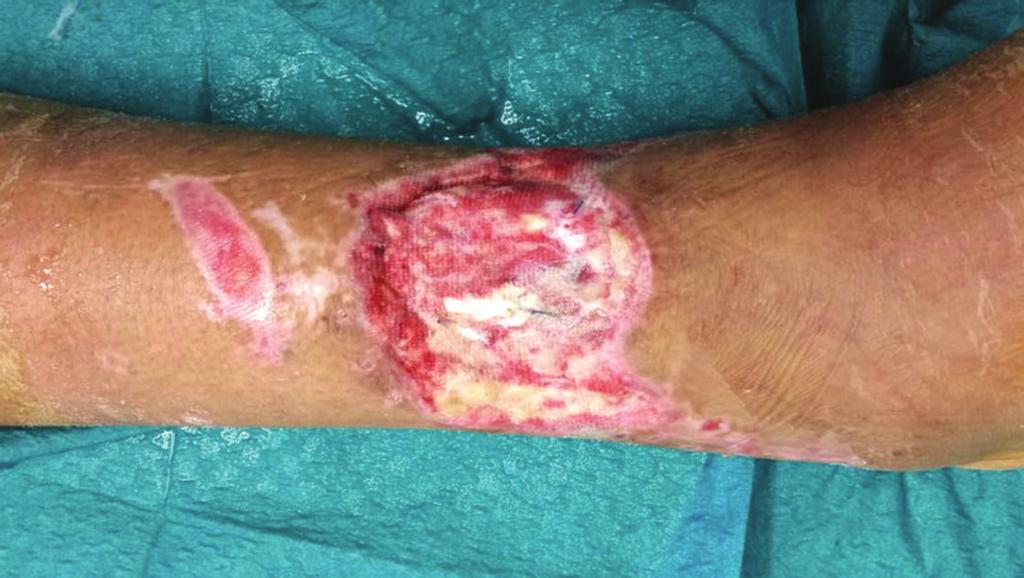 (d) A partial thickness skin graft placed on regenerated dermal tissue. After debridement, ADM placement, and skin grafting we used a negative pressure wound therapy (NPWT).