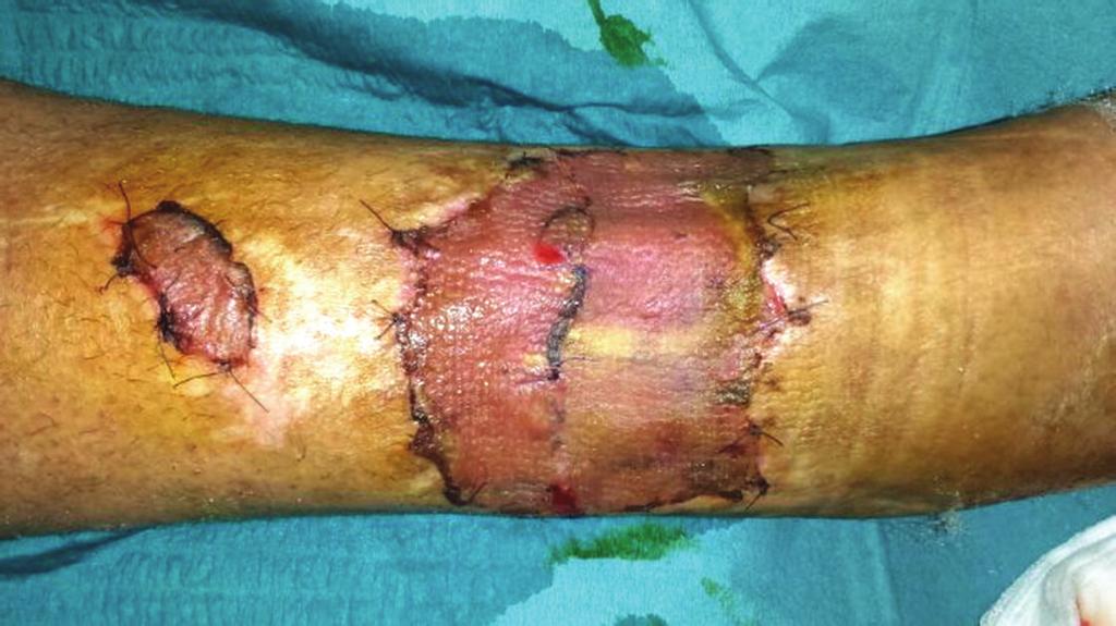 We used the association of negative pressure wound therapy (NPWT), acellular dermal matrix (ADM), and skin graft in a patient with traumatic defect of the lower third of the leg. 2.