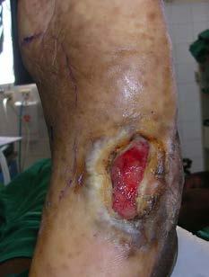 STSG The M edial Plantar Flap is taken from the instep of the sole of the foot and is