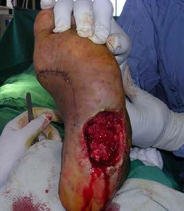 This vessel travels beneath the abductor hallucis tendon to supply the sole of the foot.