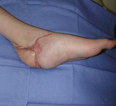 artery because of the injury on the lateral side of