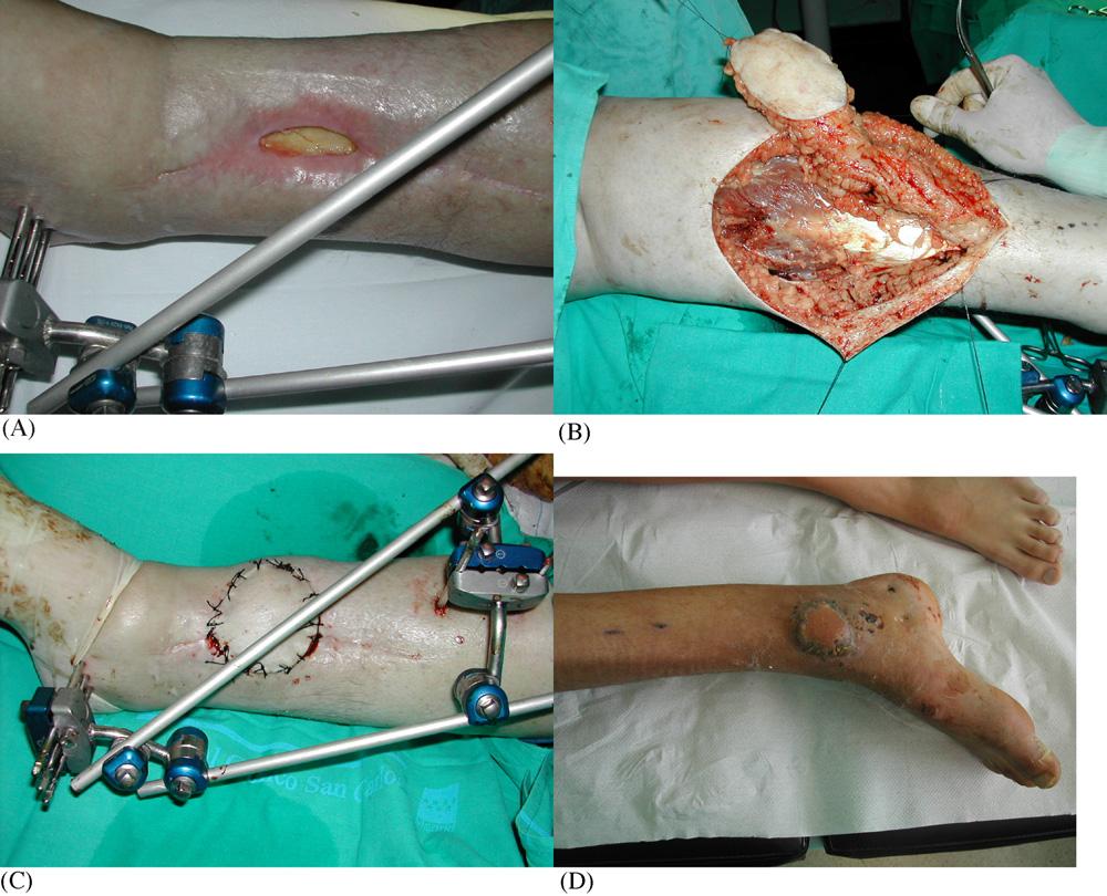 Versatility of sural fasciocutaneous flap in defects of lower limb 825 The sural fasciocutaneous flap is useful for the treatment of complex injuries of the lower limbs and their complications.