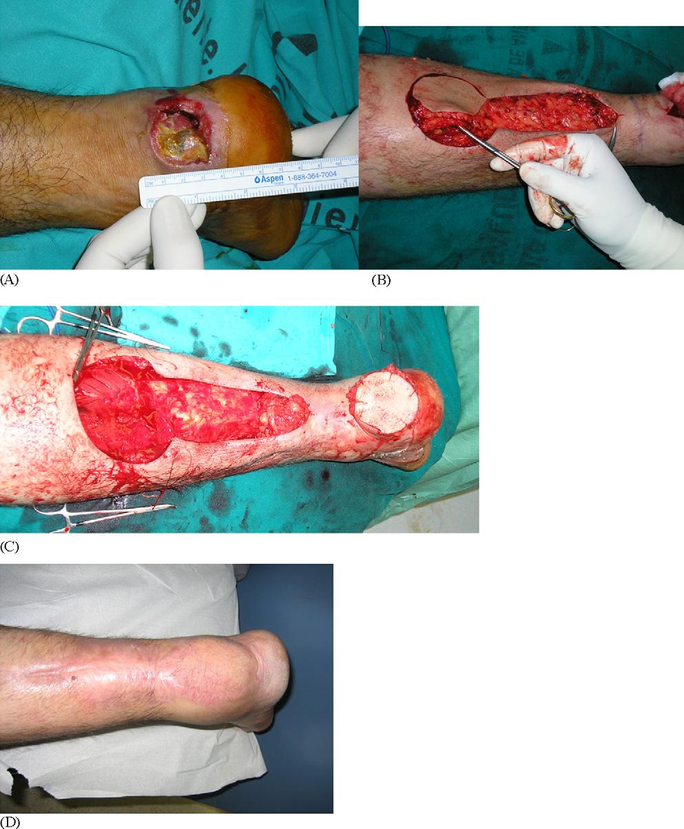 826 A. Ríos-Luna et al. Figure 2 (A D) Case 4. A calcaneous fracture and skin necrosis. Final result. patients we used spinal anaesthesia and they were positioned prone.