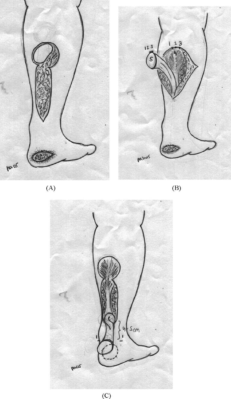 Versatility of sural fasciocutaneous flap in defects of lower limb 829 Figure 4 (A) This flap cannot be delineated further than the junction of the heads of the gastrocnemius.
