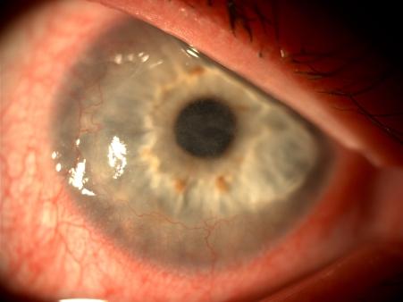J Biomed Clin Res Volume 3 Number 1, 2010 corneal ulcer in a zone of 2 mm of the limbus, the overlying epithelium is absent and in the affected area the underlying stroma is thinned, the edge is