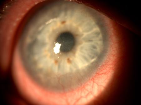 In severe cases, the destruction of the cornea progresses centrally and circumferentially. The process is usually unilateral and limited to one sector but may also be bilateral and extensive.