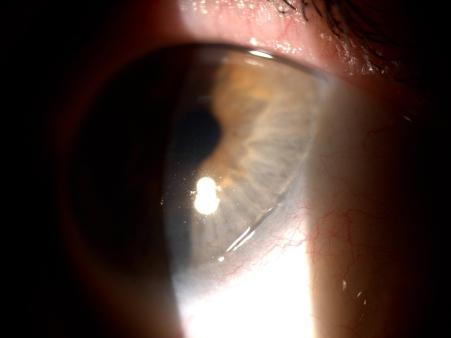 Murgova S., Balabanov Ch. Corneal melting A 76- year-old male presented with complaints of irritation, foreign body sensation and redness in his left eye.