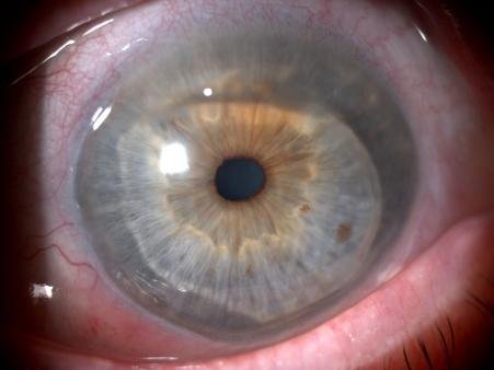 Ocular examination showed circumferential stromal thinning, superficial new blood vessels and moderate injection of conjunctiva. Visual acuity for left eye was 0.5.