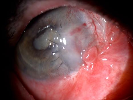 J Biomed Clin Res Volume 3 Number 1, 2010 The follow-up examination two weeks later revealed that the corneal graft was nontransparent, with superficial and deep new blood vessels, and epithelized