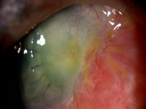 The remainder of the cornea was clear, the melting on the limbus had not progressed. The pupil was irregularly shaped, narrow with synechia. The lens examination revealed intumescent cataract.