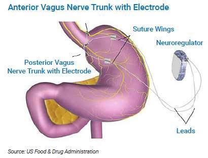 Electrodes placed around anterior and posterior vagus nerves,