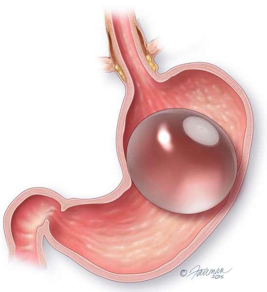 Balloon placed endoscopically, and filled with saline or air Designed to occupy room in the stomach