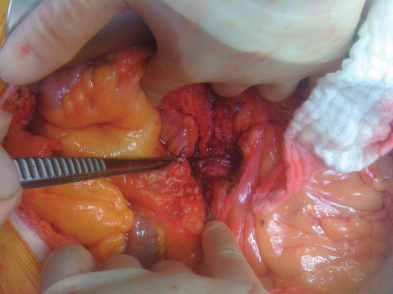 Journal of Gastrointestinal Oncology Vol 6, No 3 June 2015 257 A B C D Figure 1 Application of 5-FU treated gelfoam to post dissectional tumor bed. 5-FU, 5-fluorouracil.