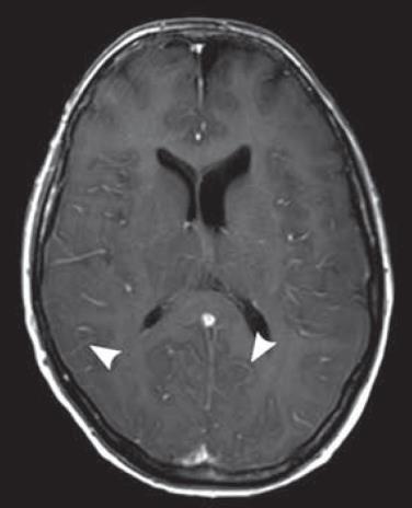 d122) MSKCC: 1 seizure ZUMA-1: 1 cerebral edema