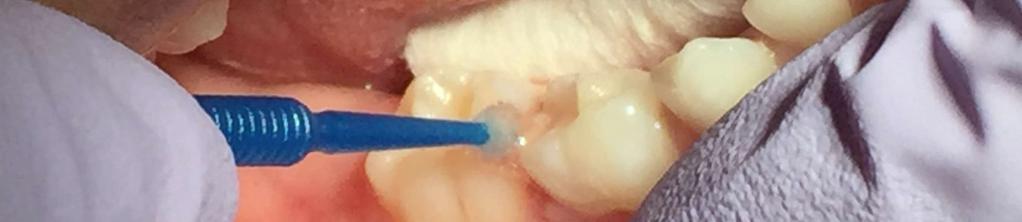 application of a caries arresting or inhibiting medicament and without mechanical