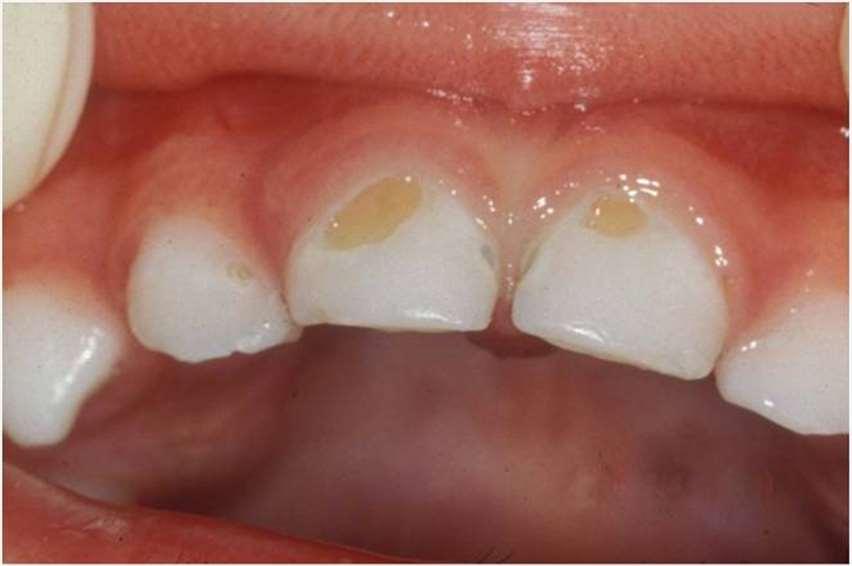 The problem: Dental Caries in children Affects