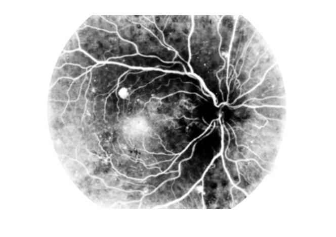 Threshold function is used for feature extraction of the fundus image. III.
