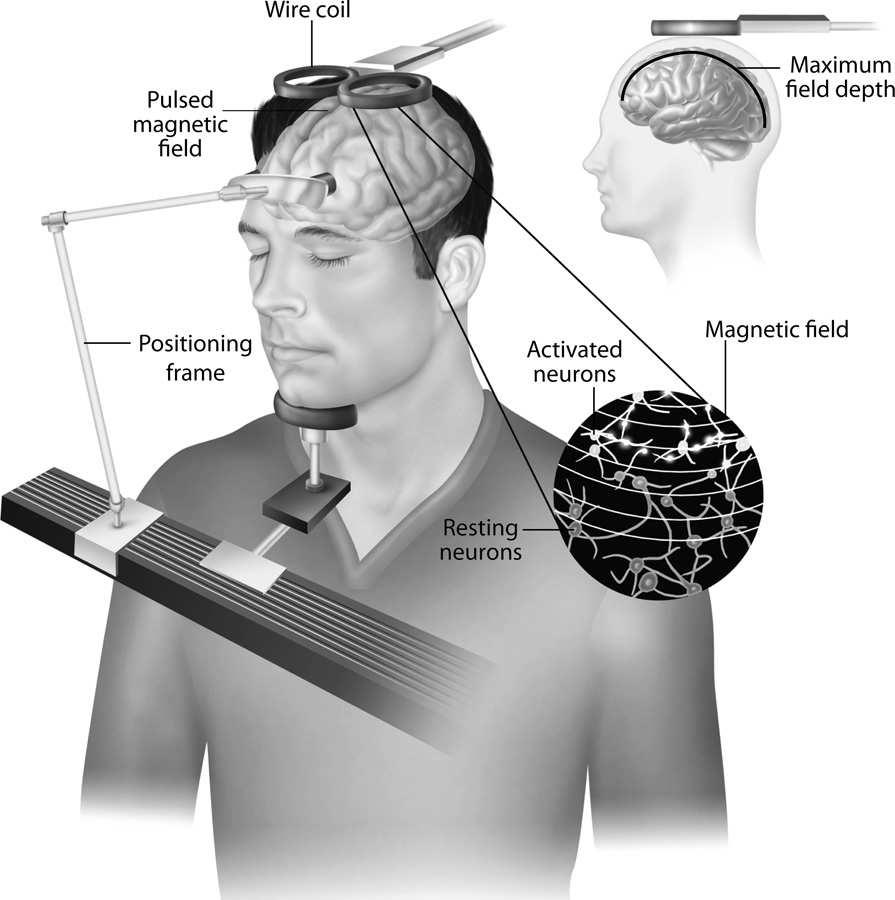 Search for less intense brain stimulation treatment: Repetitive Transcranial Magnetic Stimulation (rtms) C17:55 Psychosurgery Surgery removes or destroys brain tissue to change behavior Lobotomy