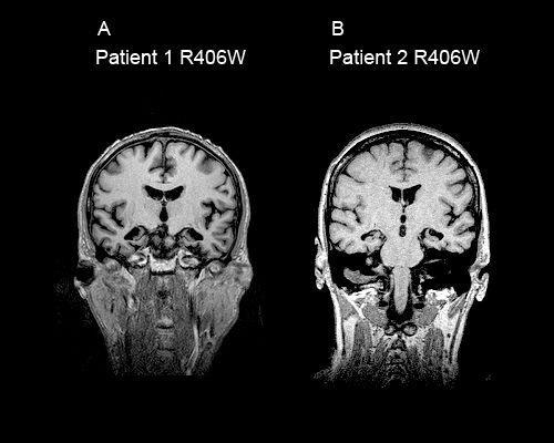 Figure 1 Coronal MRI in R406W mutation patients Figure 1 illustrates severe, strictly isolated, symmetrical medial temporal lobe atrophy in patients 1 (panel A) and 2 (panel B).