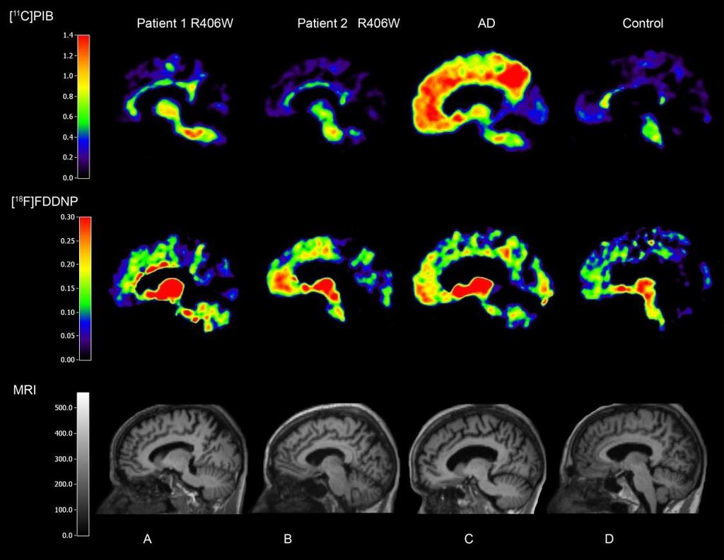Figure 2 [ 11 C]PIB and [ 18 F]FDDNP PET and MRI in R406W mutation patients together with AD and control Panel A=patient 1, B=patient 2, C=Alzheimer s disease patient, D=healthy control.