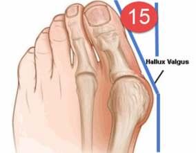Test 4 Bunion or Hallux Valgus on the Big Toe Definitions: The Hallux (see page 2 to view the foot s bone anatomy) are the two bones that make up our big toe.