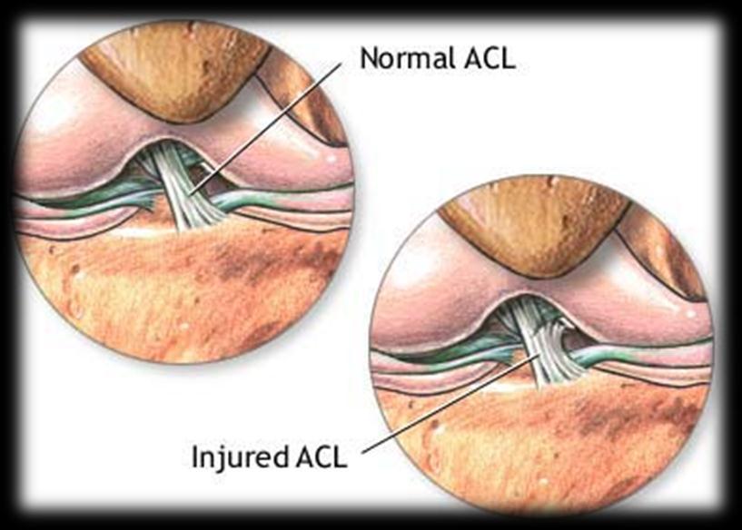 The ACL limits internal rotation of the tibia.