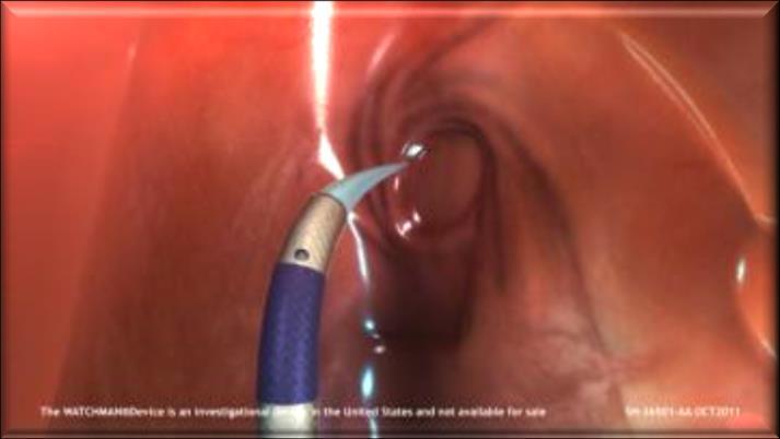 WATCHMAN : Device Implant Procedure SH-102103-AD- APR 2013 Procedure is performed under either general anesthesia or conscious sedation with fluoroscopic and transesophageal echocardiography (TEE)