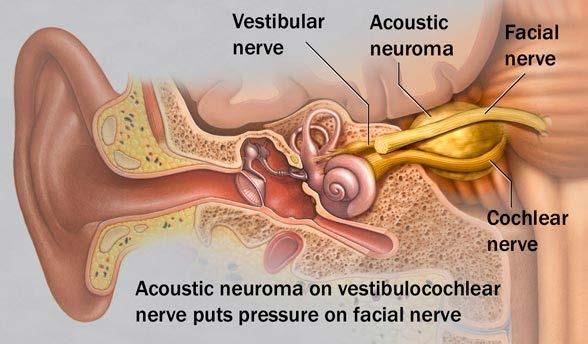 Other Peripheral causes of Dizziness Acoustic neuroma: - Slow growing tumor - Patients often experience mild vertigo or no