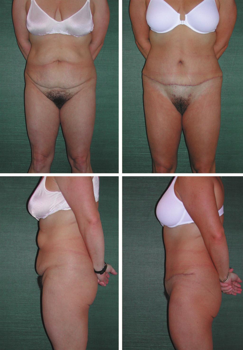 Plastic and Reconstructive Surgery April 2008 Fig. 2. A 36-year-old woman, 5 feet 2 inches tall, after a 78-pound weight loss, with good skin tone and laxity confined mainly to the lower abdomen.