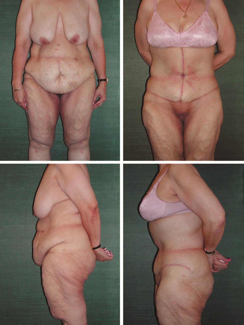Volume 121, Number 4 Contouring after Massive Weight Loss Fig. 3. A 48-year-old woman, 5 feet 2 inches tall, after a 101-pound weight loss.