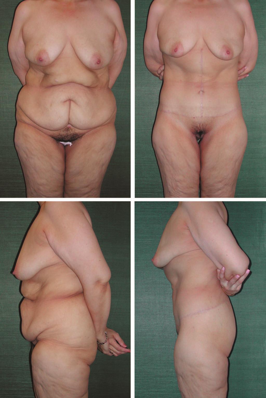 Volume 121, Number 4 Contouring after Massive Weight Loss Fig. 5. A 47-year-old woman, 5 feet 6 inches tall, after a 107-pound weight loss.