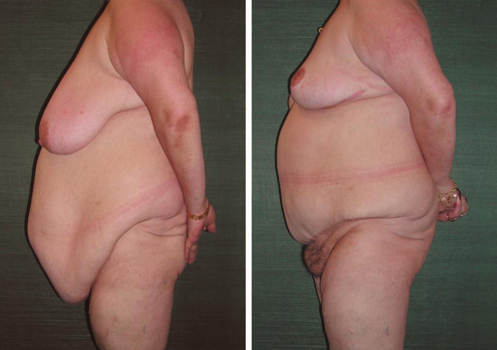 She had a significant amount of fat in her subcutaneous component circumferentially and had a previous upper vertical midline incision. She was still actively losing weight.