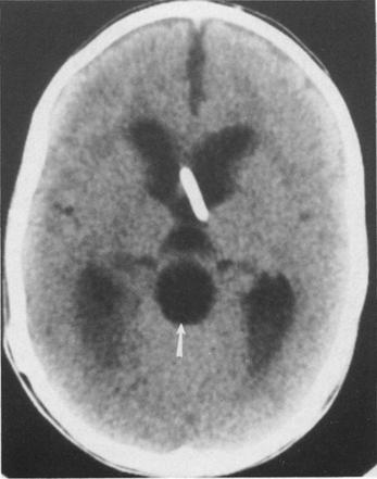 The dorsal margin of the cyst wall originates from the caudal portion of the cerebellar component of the malformation, and the ventral wall arises from the caudal extremity of the medullary kink.