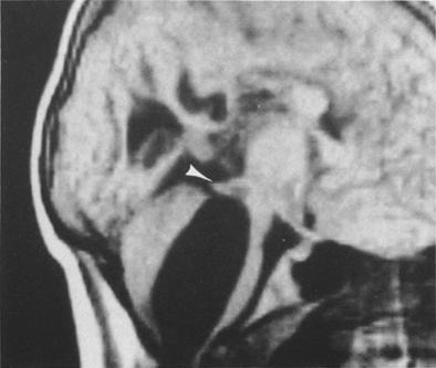 We were impressed with the dichotomy between the aim of surgery in patients with Arnold-Chiari I deformity (that is, "decompress the cerebellar tonsils and permit egress of CSF from the fourth