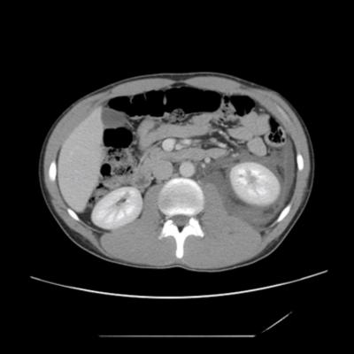 Figure 2 Figure 2: Image from the intial contrast enhanced CT scan reveals moderate sized circumferential perinephric fluid collection.