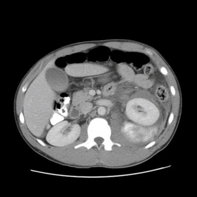 The patient was admitted to hospital for observation. The next day, the patient experienced increasing abdominal pain and an ileus developed.