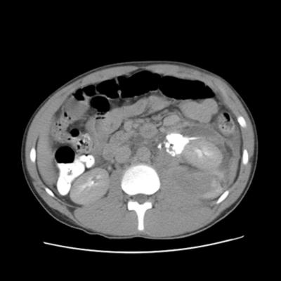 Figure 4 Figure 4: Delayed contrast enhanced CT image shows contrast extravasation into the medial aspect of the anterior perirenal space.