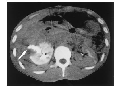 Computed tomography scan of a right renal stab wound (grade IV),