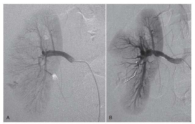 Angioembolization of renal laceration: A, Arteriography demonstrating active arterial bleeding.